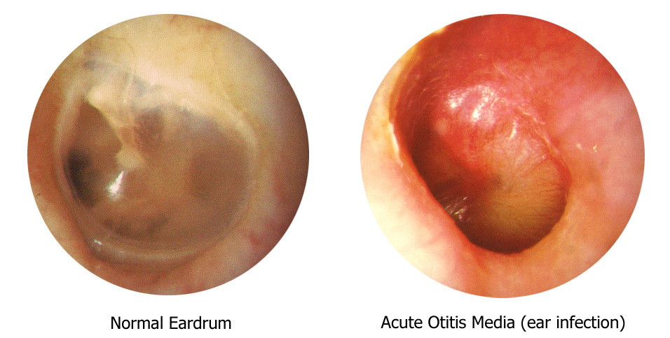 The Appearance of a Middle Ear Infection