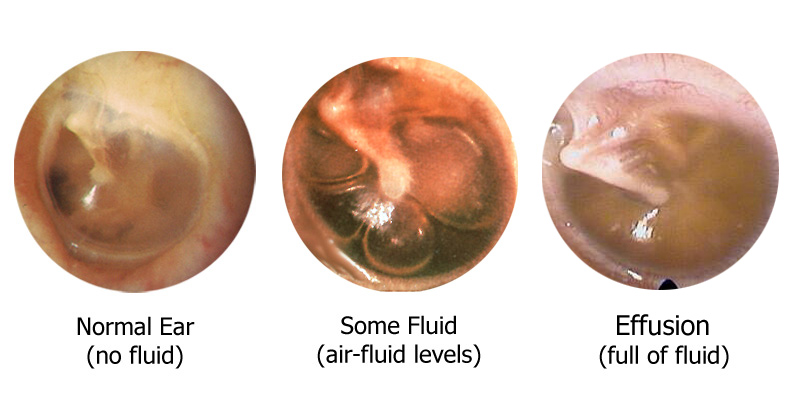 Middle Ear Effusion (Fluid)